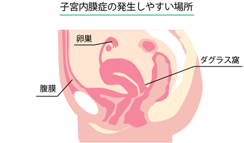 子宮内膜症の発生しやすい場所